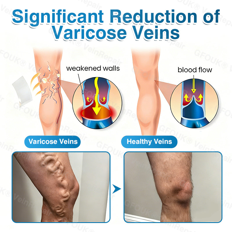 🇨🇦👨‍⚕️✅👍KLENIMORE™ VeinRepair Microneedle Patch Roll⚡Instant Relief, Long-Term Results