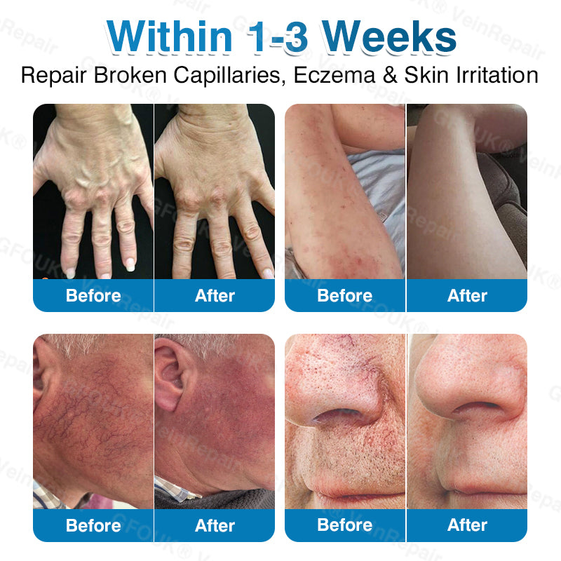 🇺🇸👨‍⚕️✅🥇KLENIMORE™ VeinRepair Microneedle Patch Roll⚡Instant Relief, Long-Term Results