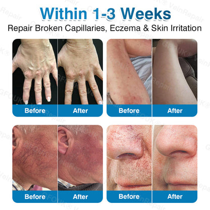 🇺🇸👨‍⚕️✅🥇KLENIMORE™ VeinRepair Microneedle Patch Roll⚡Instant Relief, Long-Term Results