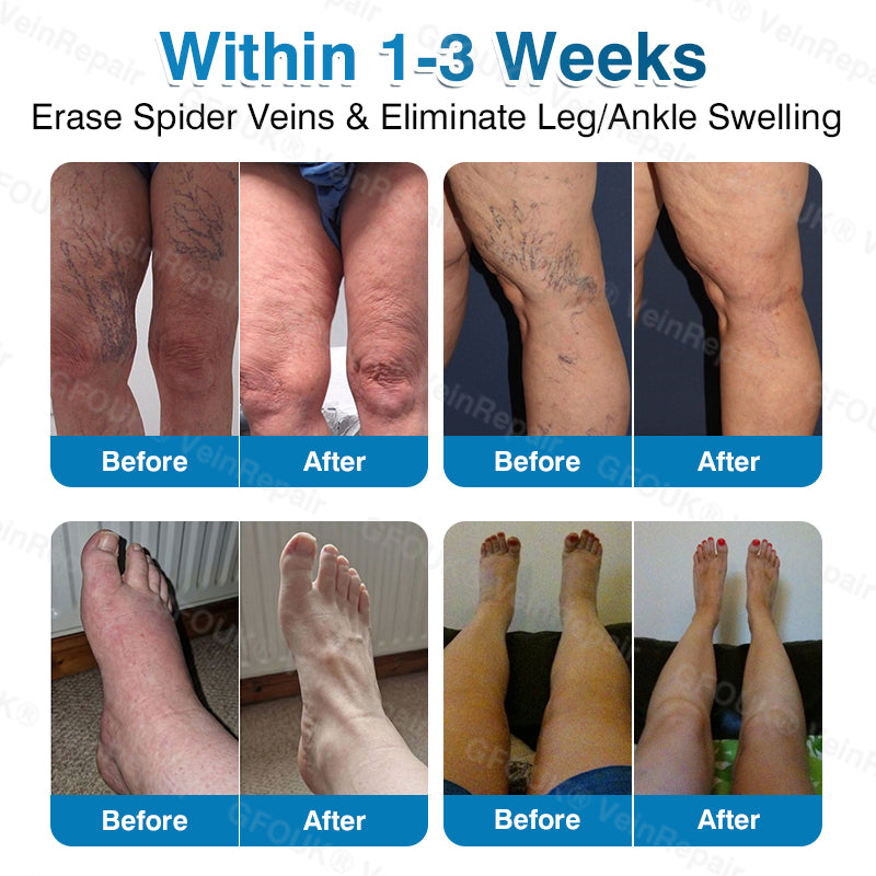 🇺🇸👨‍⚕️✅🥇KLENIMORE™ VeinRepair Microneedle Patch Roll⚡Instant Relief, Long-Term Results
