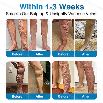🇨🇦👨‍⚕️✅👍KLENIMORE™ VeinRepair Microneedle Patch Roll⚡Instant Relief, Long-Term Results