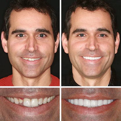 🏆Today's Special Offer 🏆2026 Bestselling Product🦷 Fit for a Fresh Smile, Say Goodbye to Wearing Discomfort!🌎