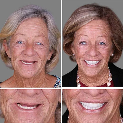 Ends Today: 75% OFF! ⏰KLENIMORE™ Medical Full Denture with Strong Suctiond Custom-Fit Full Functional Dentures🦷Obtain American Dental Association (ADA) Certification