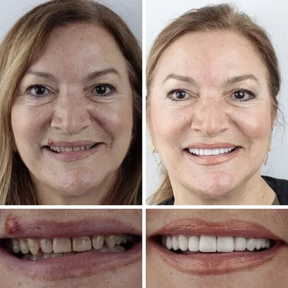 🏆Today's Special Offer 🏆2026 Bestselling Product🦷 Fit for a Fresh Smile, Say Goodbye to Wearing Discomfort!🌎