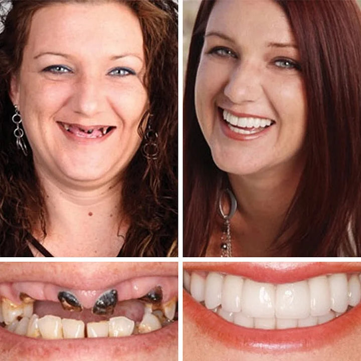 Ends Today: 75% OFF! ⏰KLENIMORE™ Medical Full Denture with Strong Suctiond Custom-Fit Full Functional Dentures🦷Obtain American Dental Association (ADA) Certification