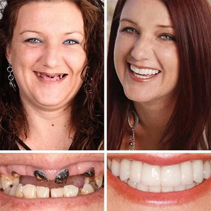 🏆Today's Special Offer 🏆2026 Bestselling Product🦷 Fit for a Fresh Smile, Say Goodbye to Wearing Discomfort!🌎